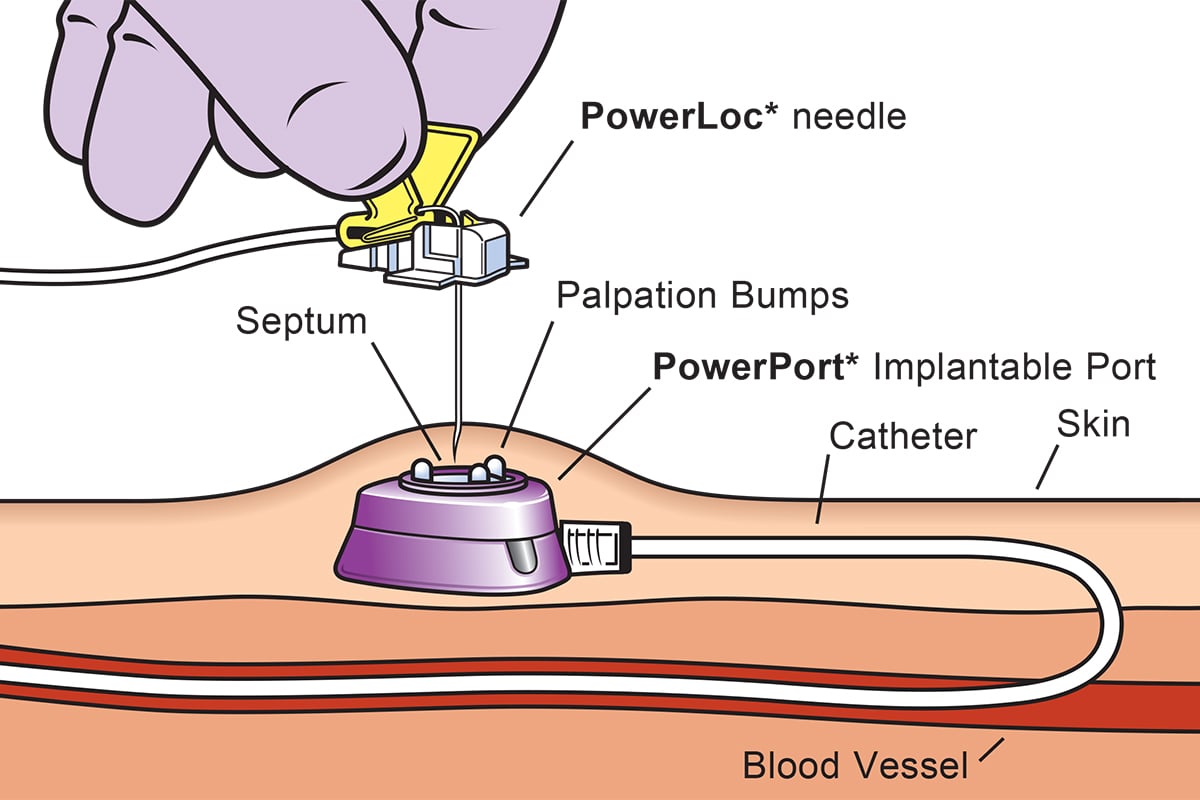Hagley Vascular (Dr Daniel Hagley) | Portacath insertion